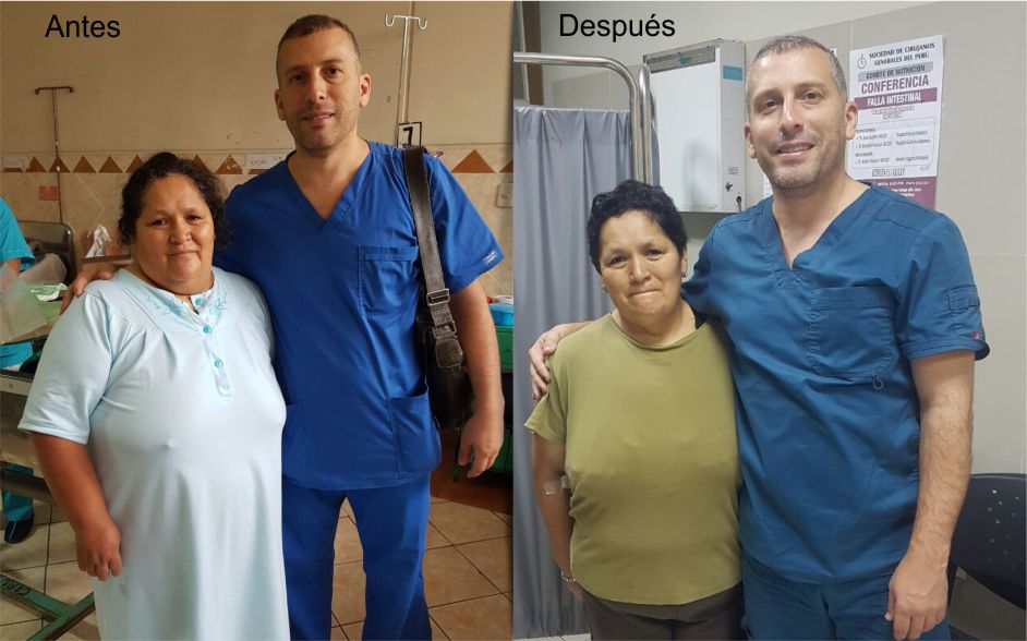 Dr. Antonio Lahoud | Cirujano bariátrico y metabólico. | Testimonios | Rayda Vargas antes y después de la cirugía de manga gástrica | Lima - Perú