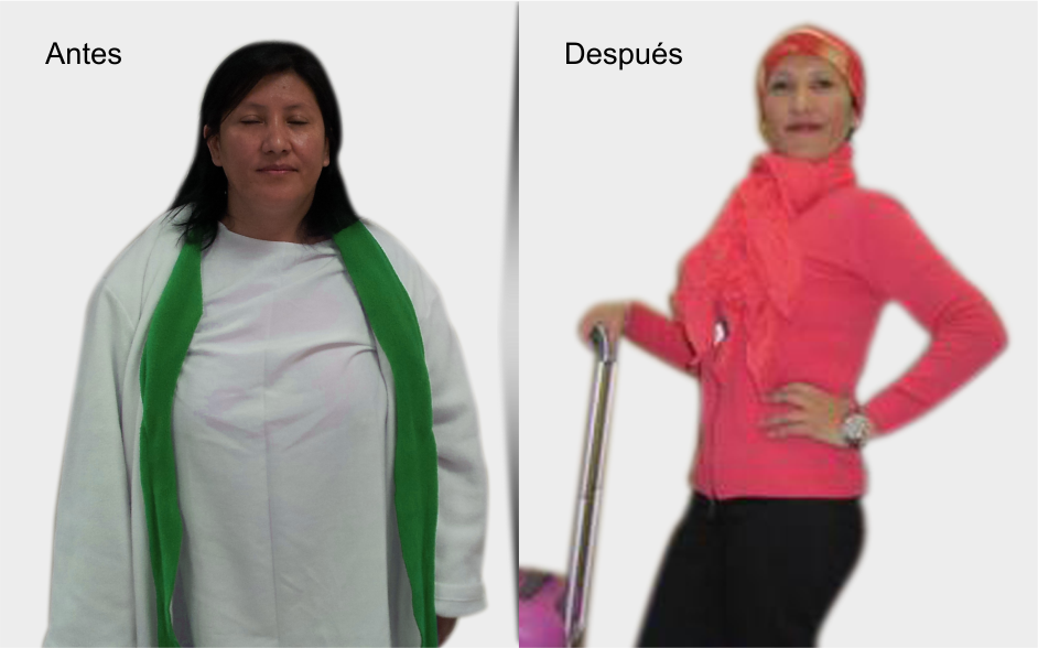 Dr. Antonio Lahoud | Cirujano bariátrico y metabólico. | Testimonios | Zarela Fernandez antes y después de la cirugía de manga gástrica | Lima - Perú
